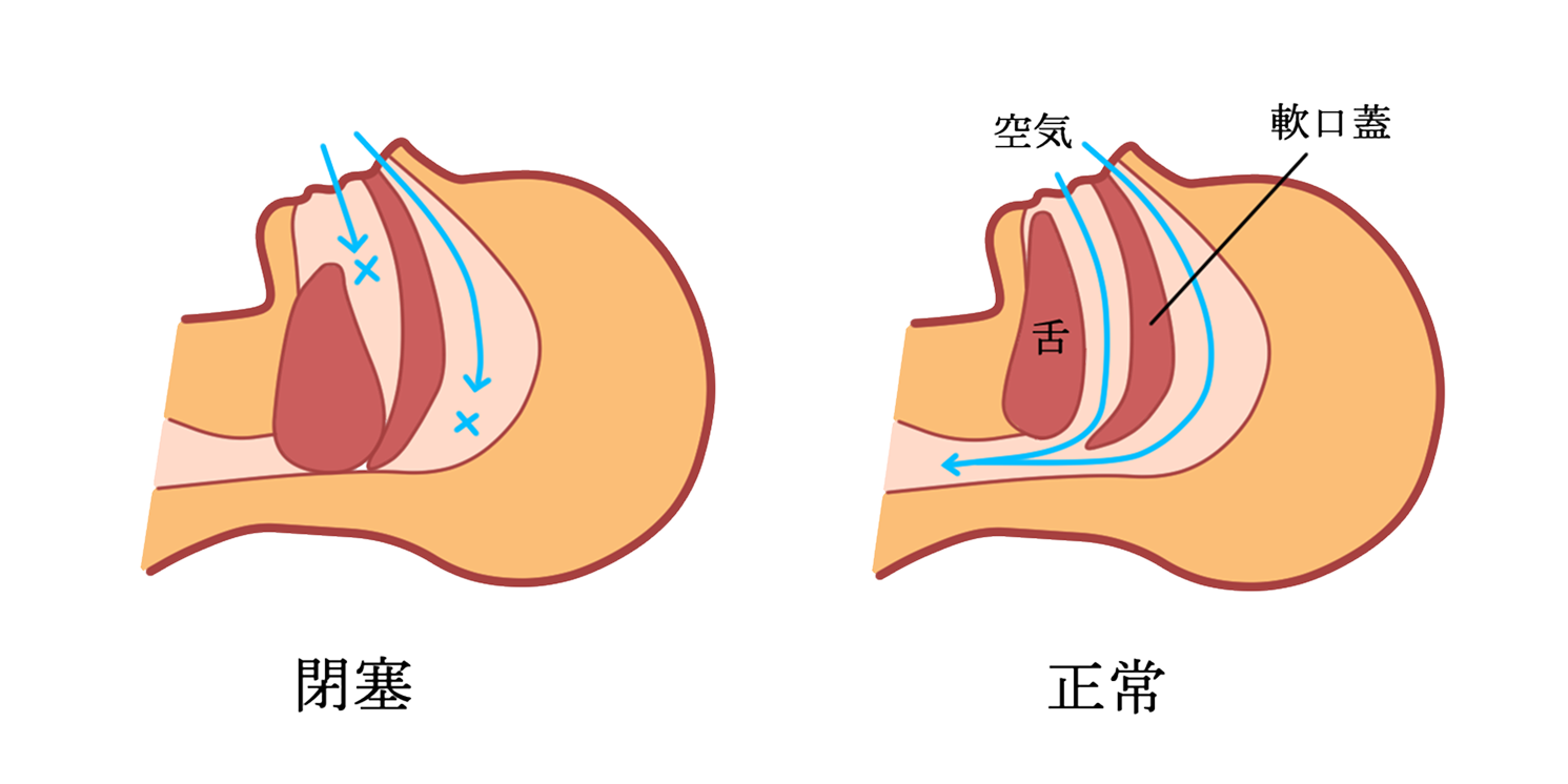 正常な場合と、閉塞時の図