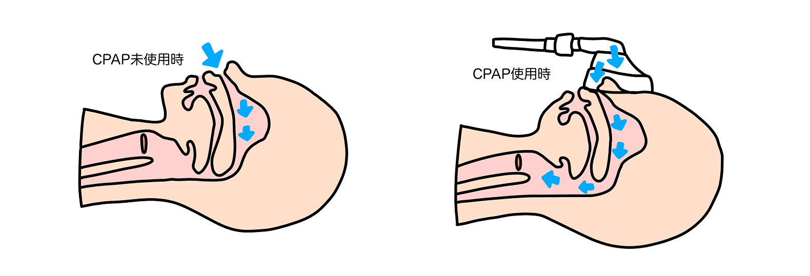 CPAP使用時の図